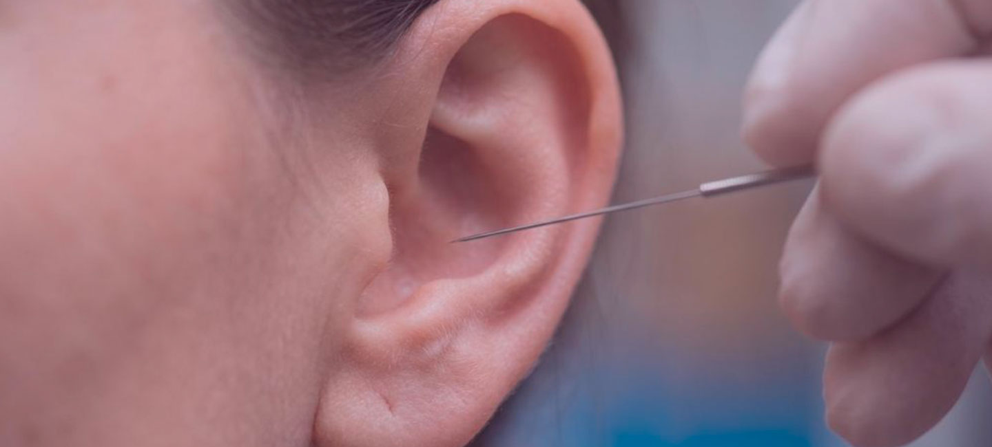 Hormonel ubalance og akupunktur: FAQ